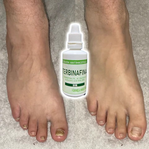Gotas de Terbinafina - Elimina Hongos