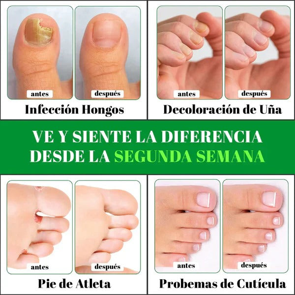 Gotas de Terbinafina - Elimina Hongos