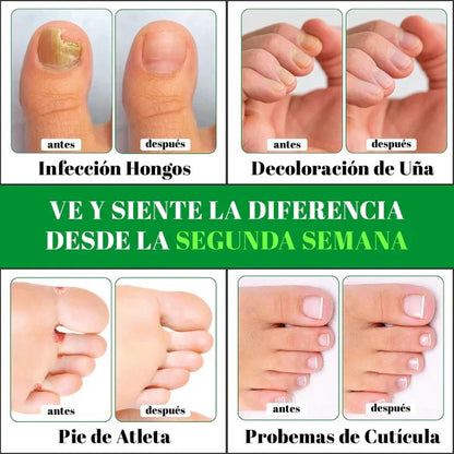 Gotas de Terbinafina - Elimina Hongos